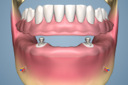 Overdenture with Teeth